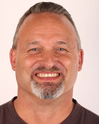 Full Mouth Reconstruction Tom - Before