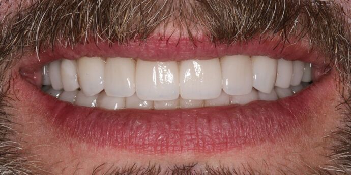 Full Mouth Reconstruction: Tom - After