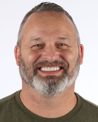 Full Mouth Reconstruction Tom - After