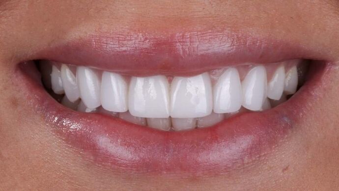 Smile Makeover & Veneers: Denise - After