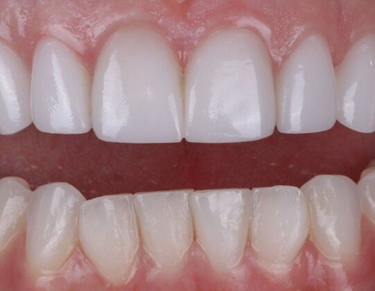 Smile Makeover & Veneers: Denise - Before