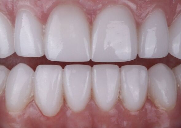 Smile Makeover & Veneers: Denise - After