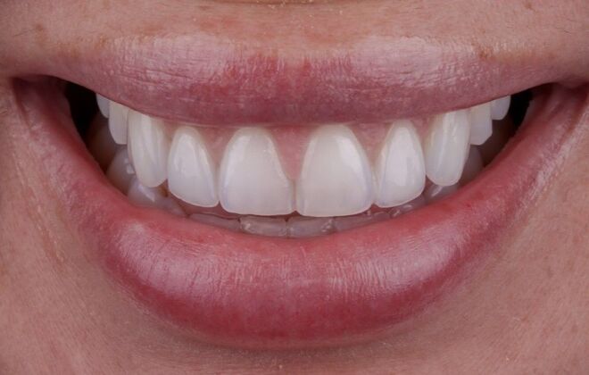 Smile Makeover & Veneers: Kathy - After