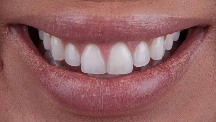 Smile Makeover & Veneers: Kathy - Before
