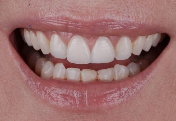 Smile Makeover & Veneers: Jenna - Before