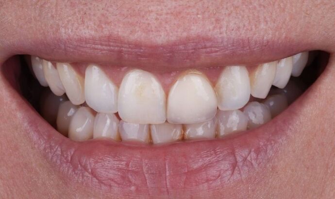 Smile Makeover & Veneers: Jenna - After