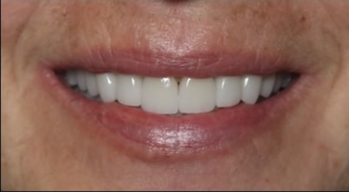 Full Mouth Restoration Cases