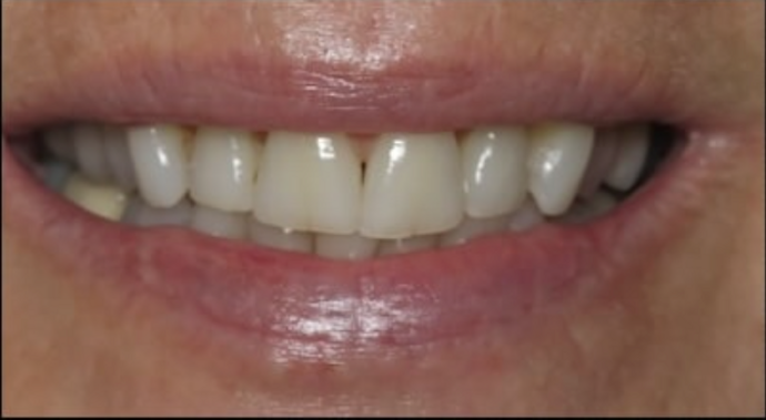 Full Mouth Restoration Case 1 - Before