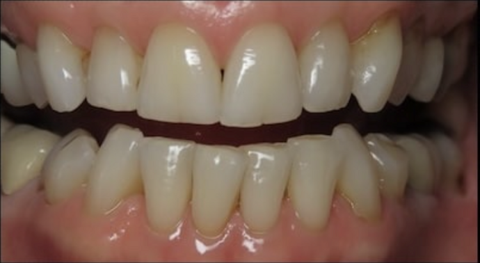 Full Mouth Restoration: Case 1 - Before