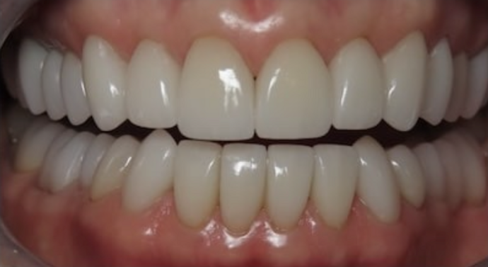 Full Mouth Restoration: Case 1 - After