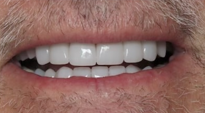 Full Mouth Restoration Case 2 - After