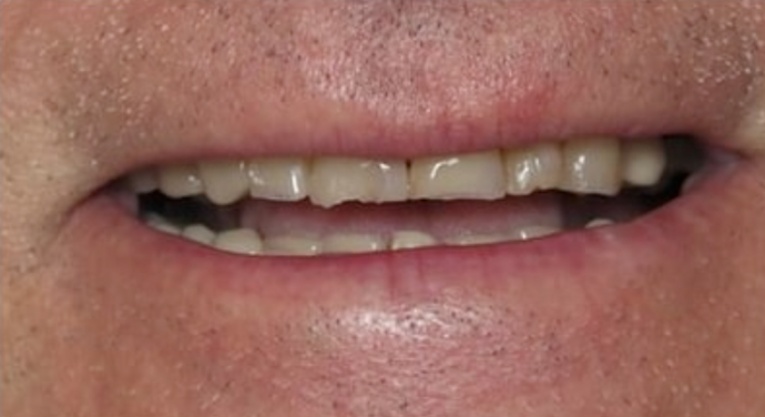 Full Mouth Restoration Case 2 - Before