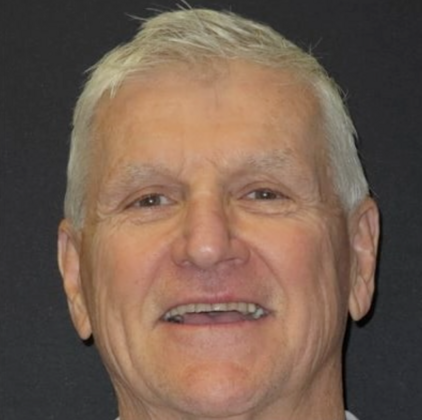 Full Mouth Restoration: Case 2 - Before