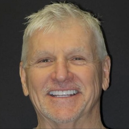 Full Mouth Restoration: Case 2 - After