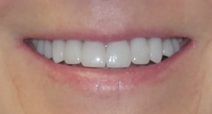 Dental Crowns Cases