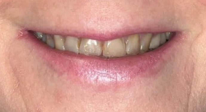 Dental Crowns Case 1 - Before