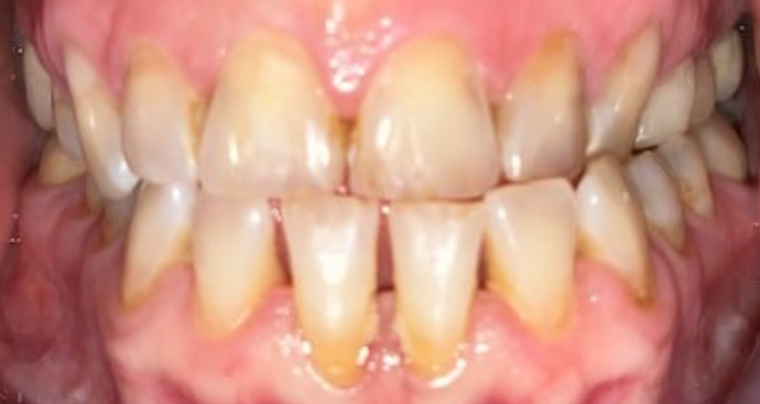 Dental Crowns: Case 1 - Before