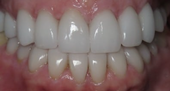 Dental Crowns: Case 1 - After