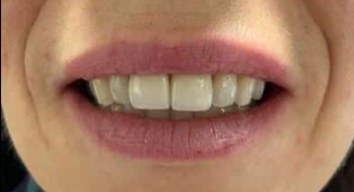 Full Mouth Restoration Case 3 - Before