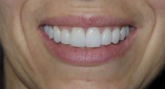 Full Mouth Restoration Case 3 - After