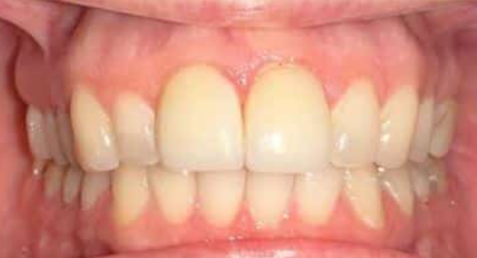 Full Mouth Restoration: Case 3 - Before