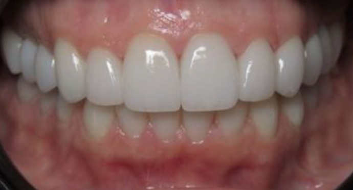 Full Mouth Restoration: Case 3 - After