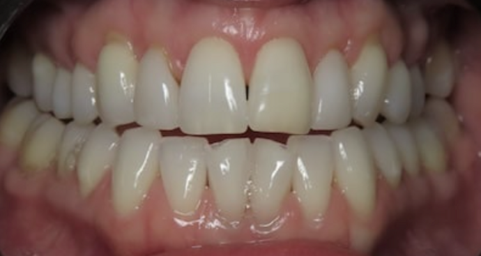 Full Mouth Restoration: Case 4 - Before