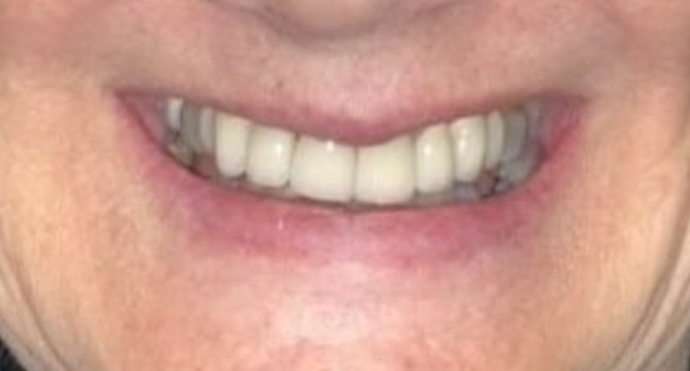 Full Mouth Restoration Case 4 - Before
