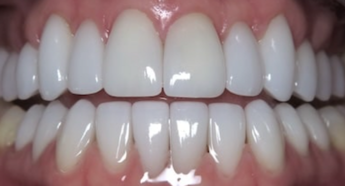 Full Mouth Restoration: Case 4 - After