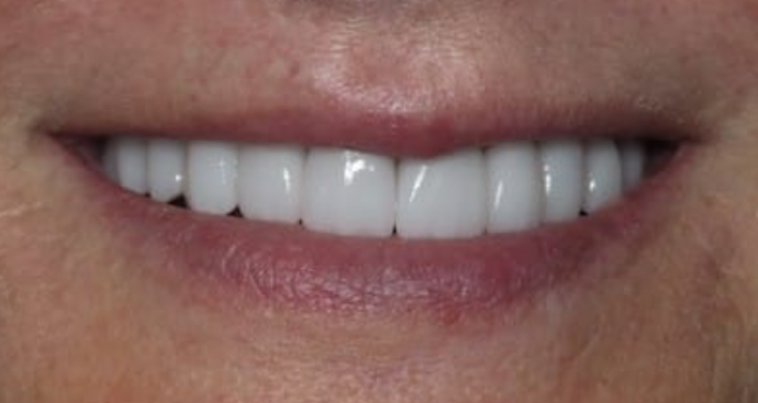 Full Mouth Restoration Case 4 - After