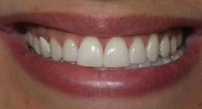 Invisalign Case