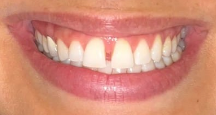 Invisalign Case 1 - Before