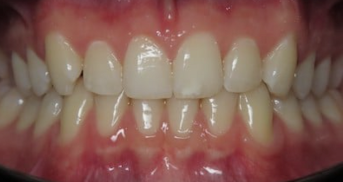 Teeth Whitening Case 1 - Before