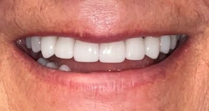 Full Mouth Restoration Case 5 - After