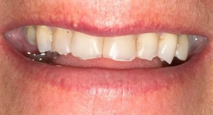Full Mouth Restoration Case 5 - Before
