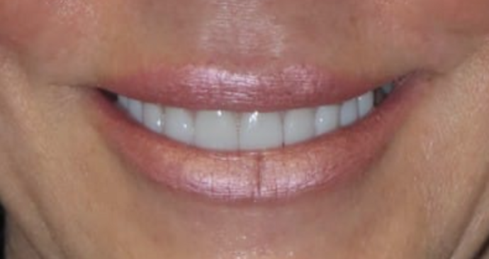 Full Mouth Restoration Case 6 - After