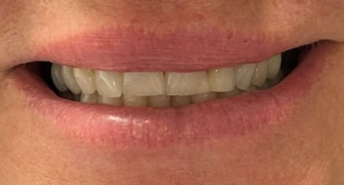 Full Mouth Restoration Case 6 - Before