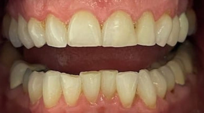 Full Mouth Restoration Case 7 - Before