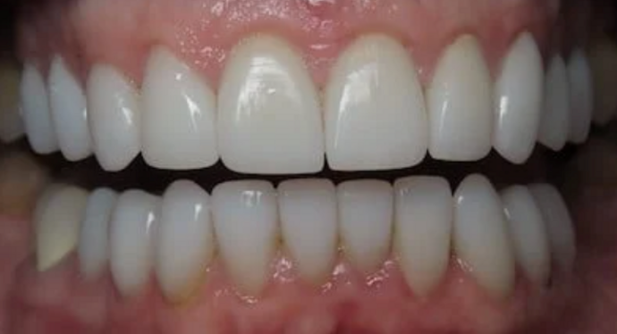 Full Mouth Restoration Case 7 - After