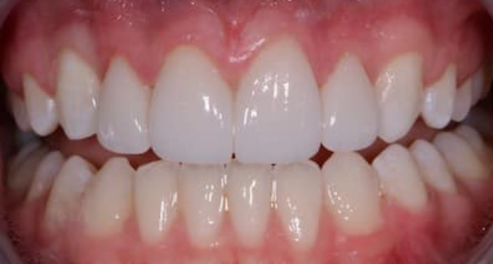 after veneers