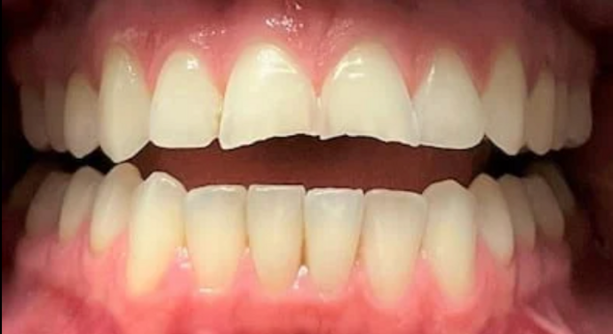 Veneers Case 2 - Before