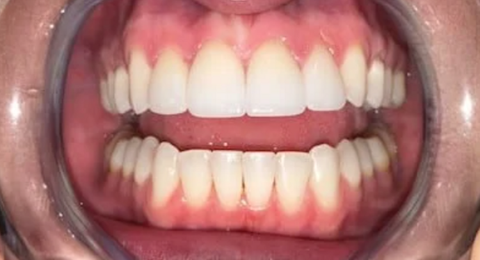 Veneers Case 2 - After