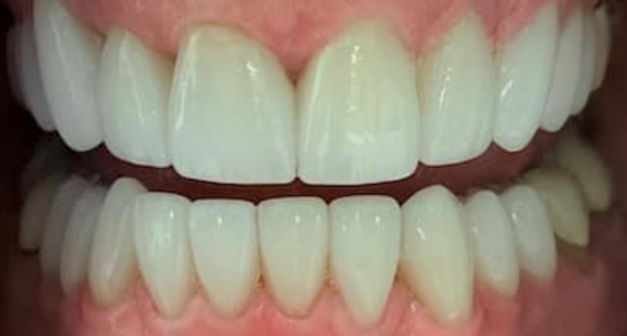 Full Mouth Restoration Case 8 - After