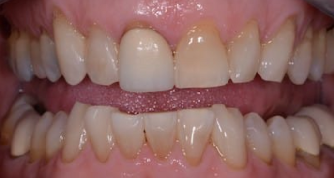 Full Mouth Restoration Case 8 - Before