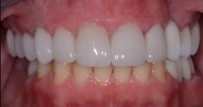 Full Mouth Restoration Case 9 - After