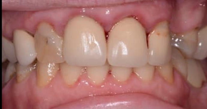 Full Mouth Restoration Case 9 - Before