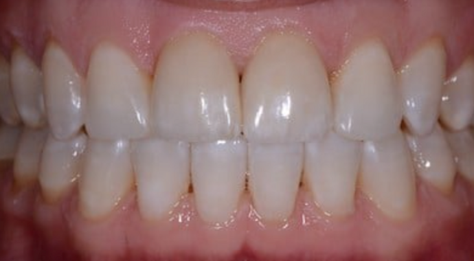 Dental Crowns Case 2 - After