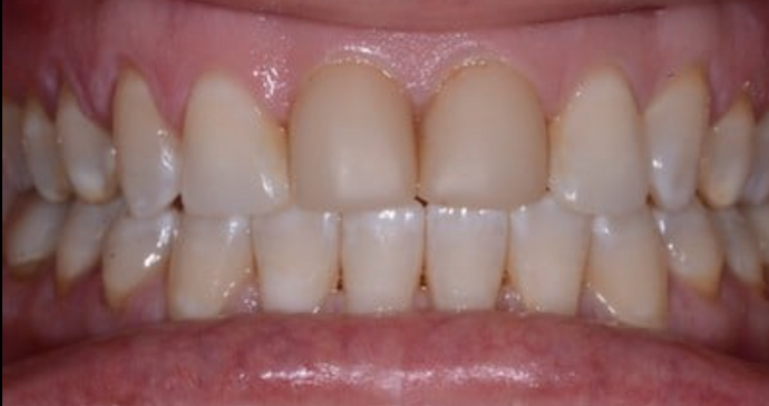 Dental Crowns Case 2 - Before