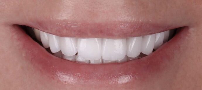 Smile Makeover & Veneers: Cathy - After