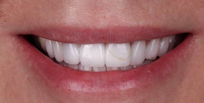 Smile Makeover & Veneers: Cathy - Before